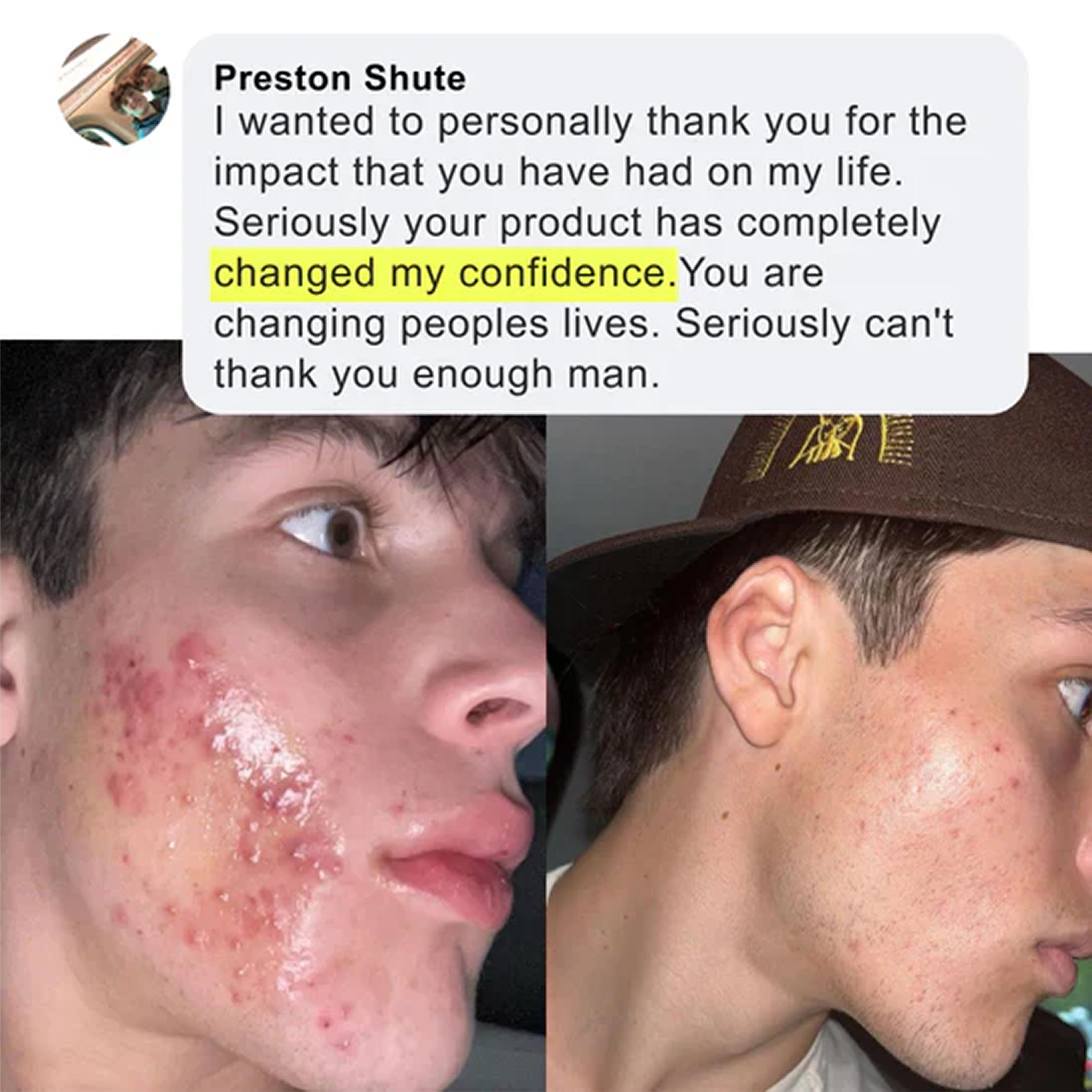 Acne Scars Healer & Preventer