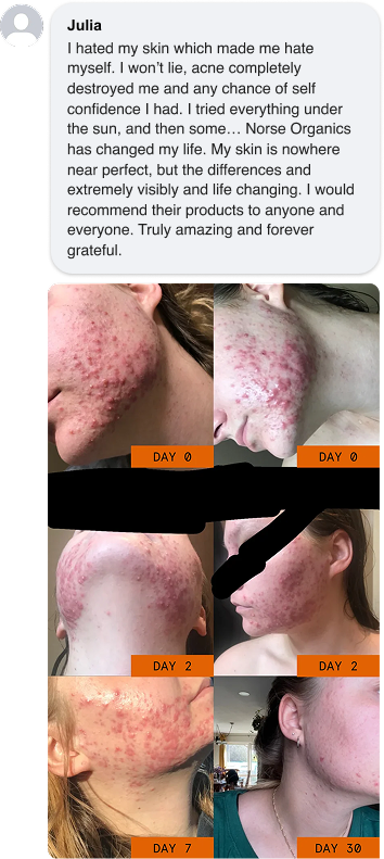 <p>Severe Acne Fixed in Weeks</p>