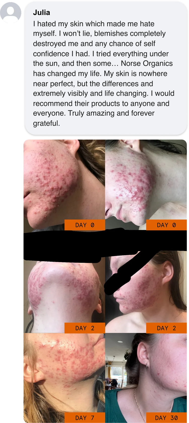 <p>Less Breakouts in Weeks</p>