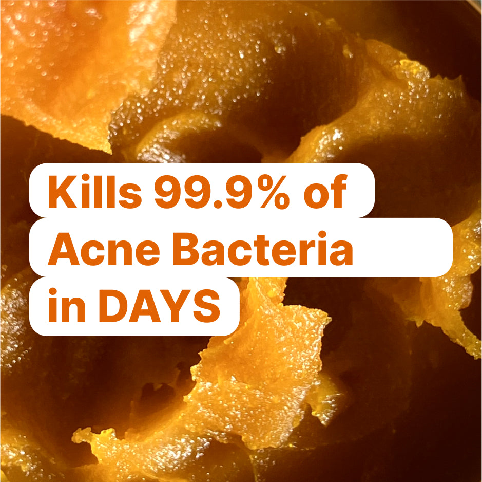 The Complete Acne Killer System 2.0