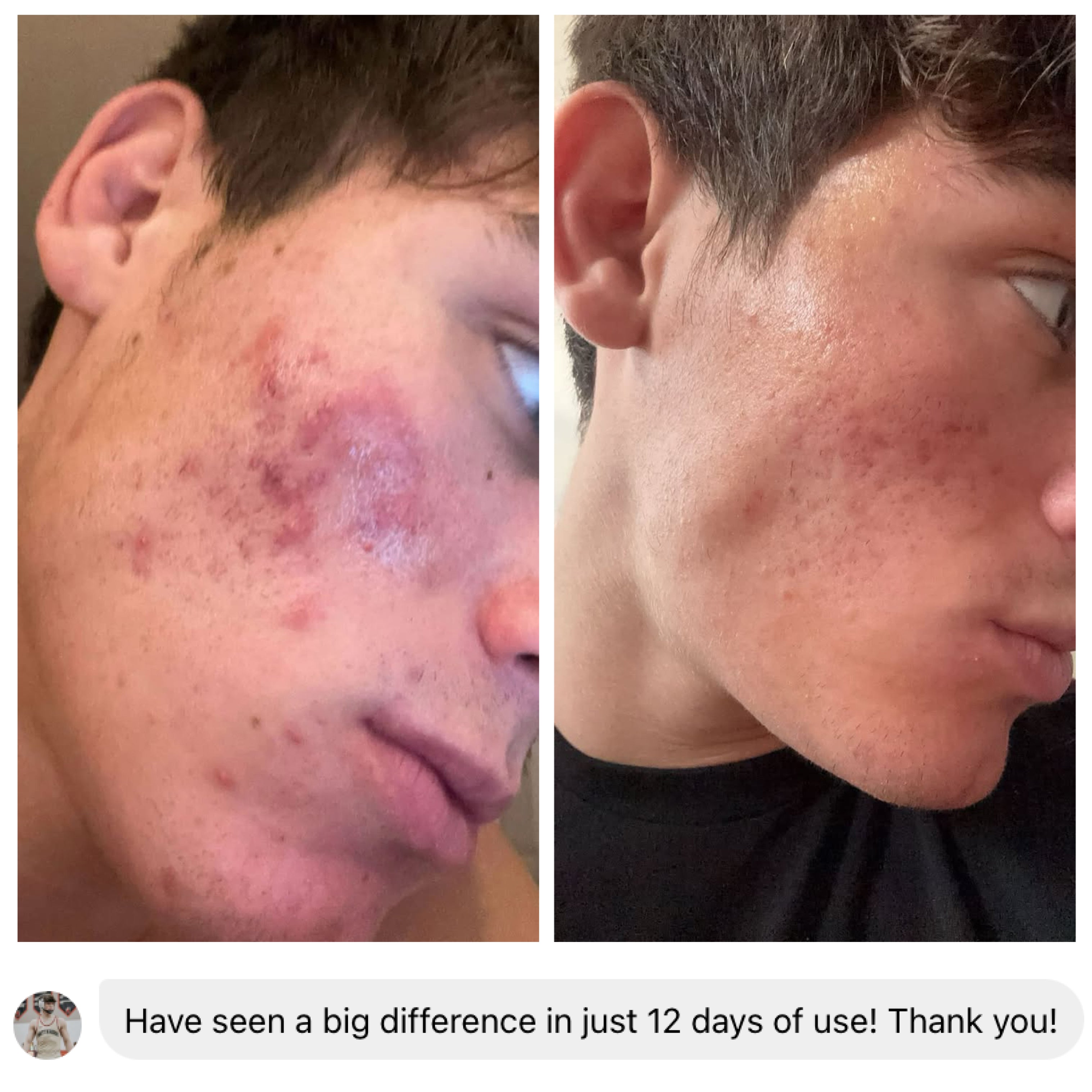 Acne Scars Healer & Preventer