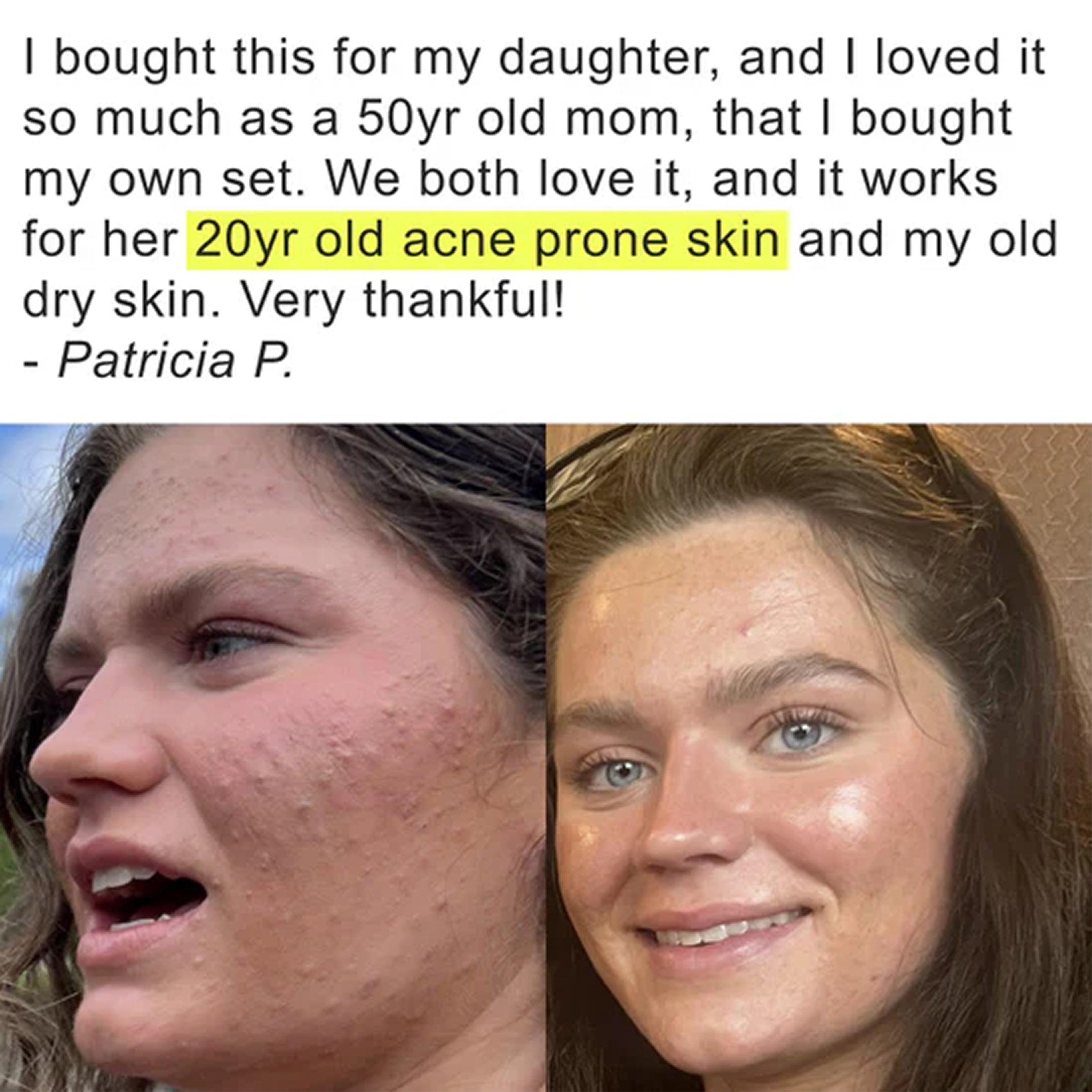 Acne Scars Healer & Preventer