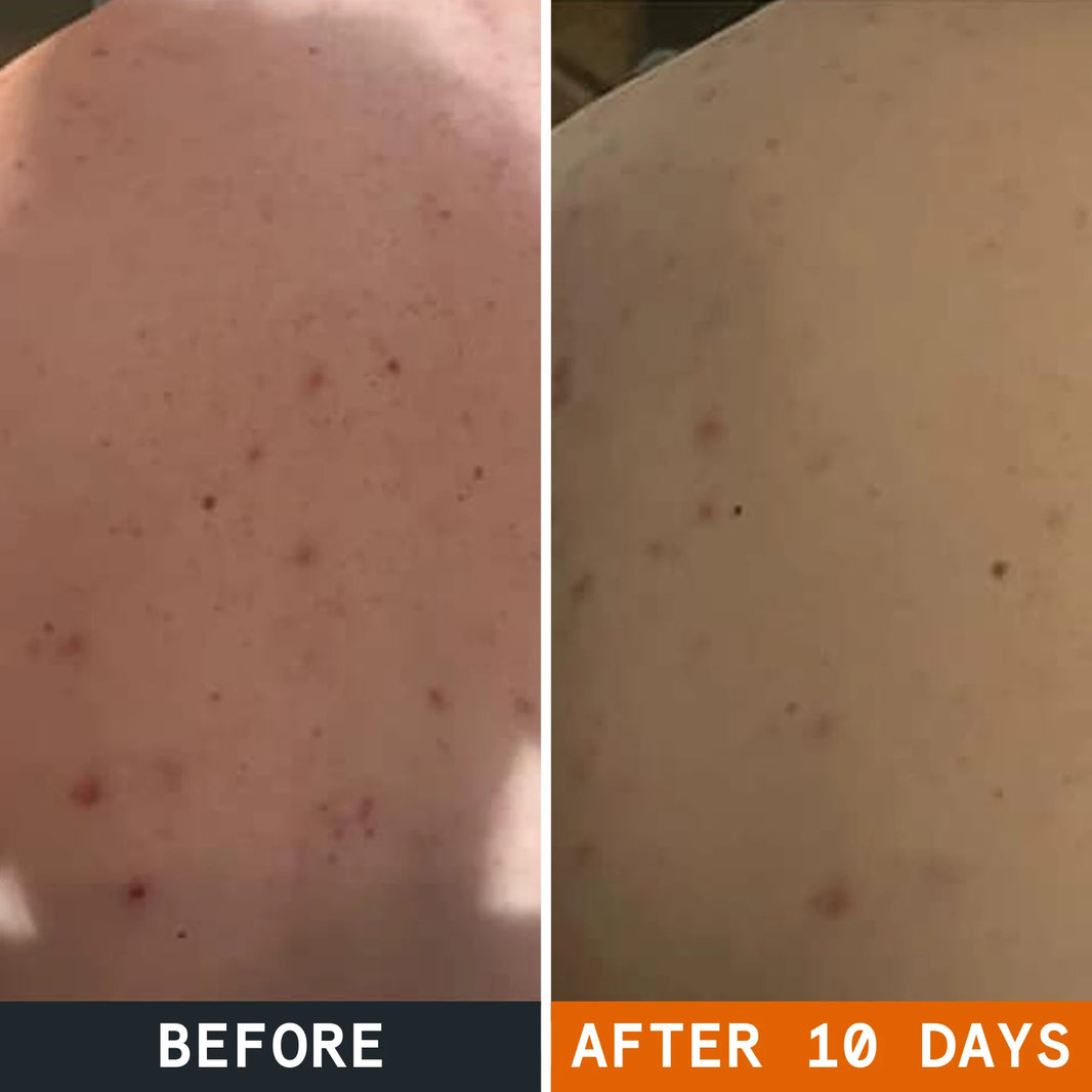 Körperseife für zu Akne neigende Haut before and after