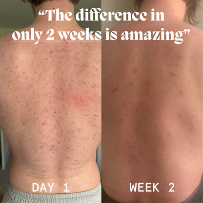 Body Balm for Acne Prone Skin