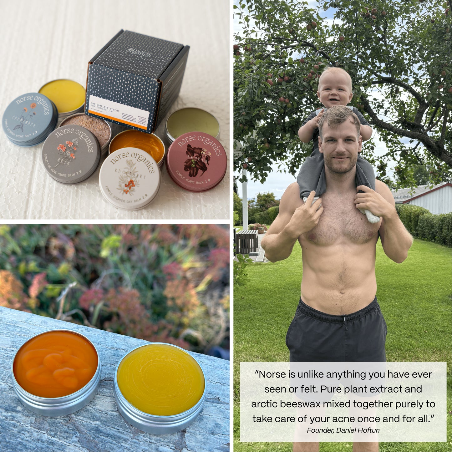 Body Balm for Acne Prone Skin