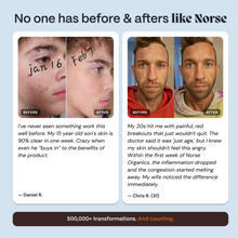 Complete Gut Repair & Hormone Health System for Male Acne-Prone Skin