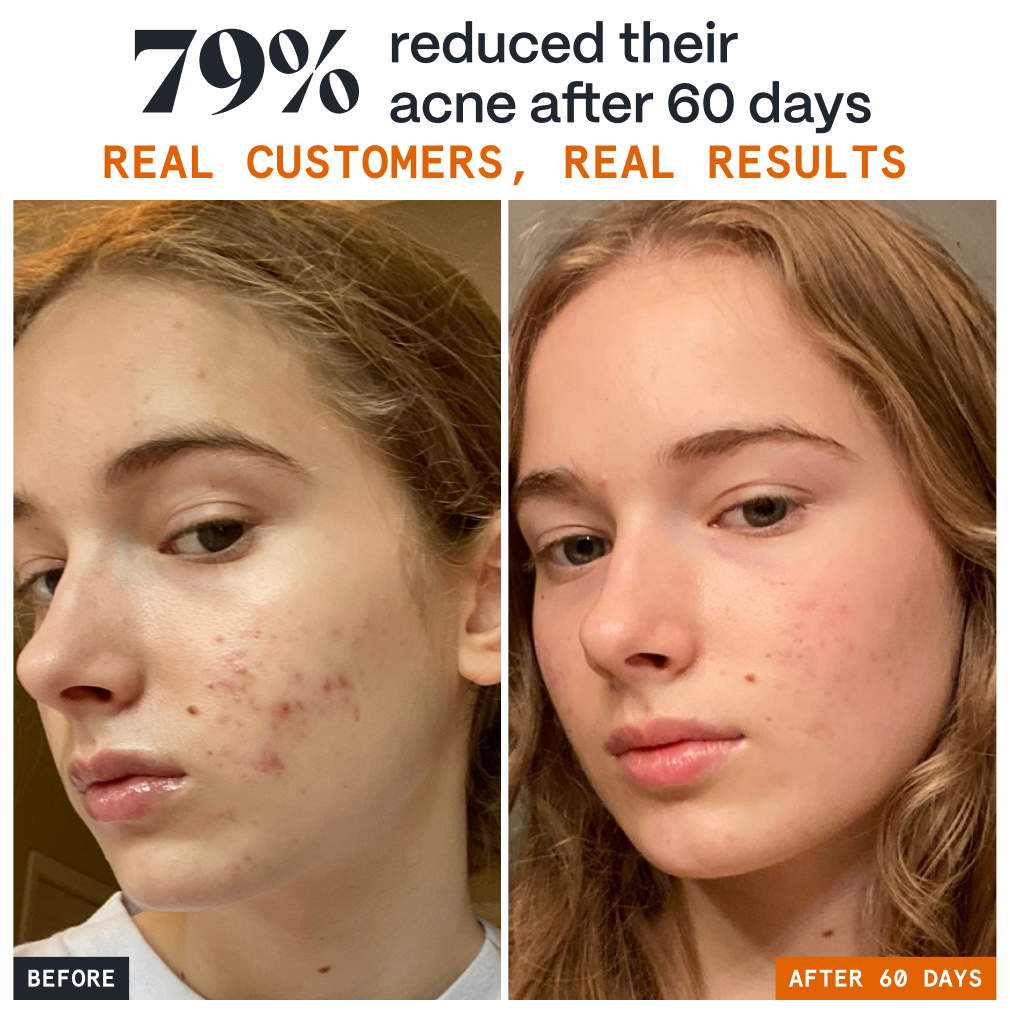 Pimple Stopper Night Balm