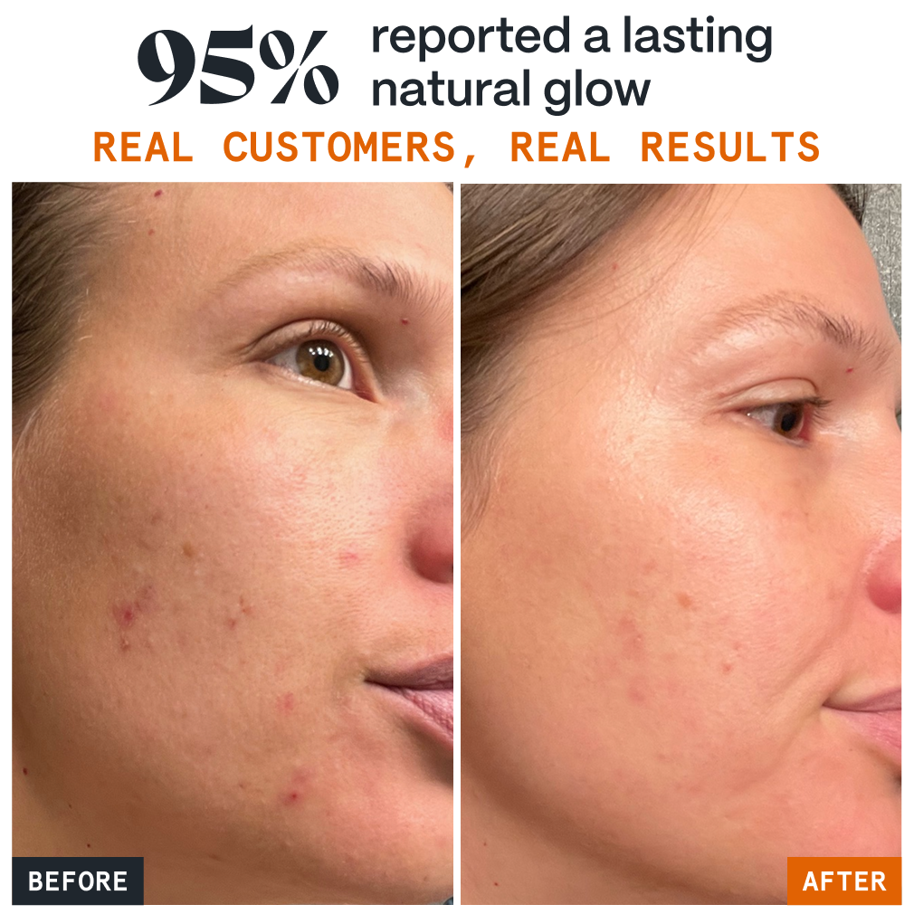 Pimple Stopper Day Balm