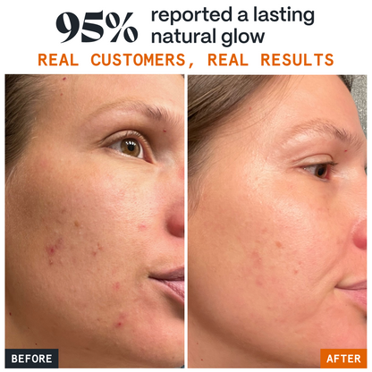 Pimple Stopper Day Balm