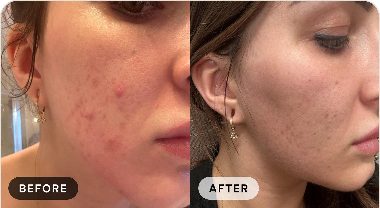 Karen's daughter before with acne scarring on her cheek, and after with even skin