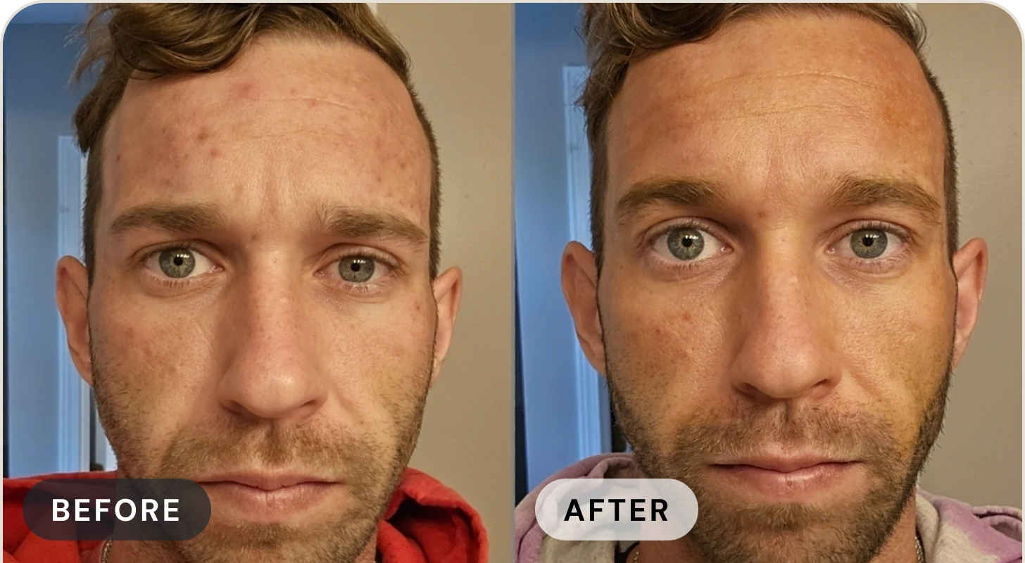 Natalia's son before with acne across his cheek, and after with clear skin