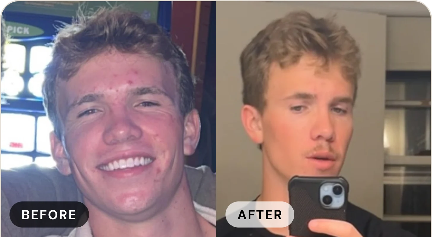 Julia before treatment with inflamed acne on her cheek, and after with clear skin