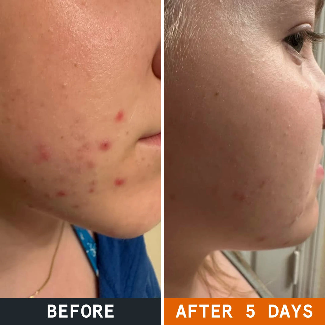 Acnepleisters met Arctische Kruiden voor Acnegevoelige Huid before and after