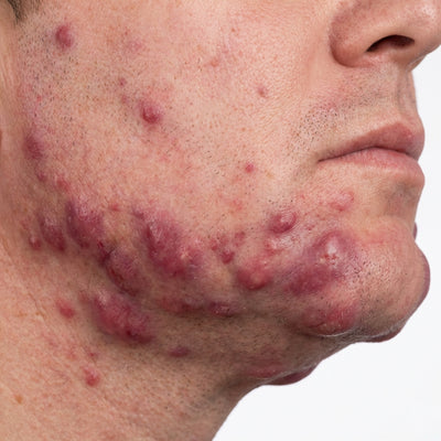 Hormonal/Cystic Acne
