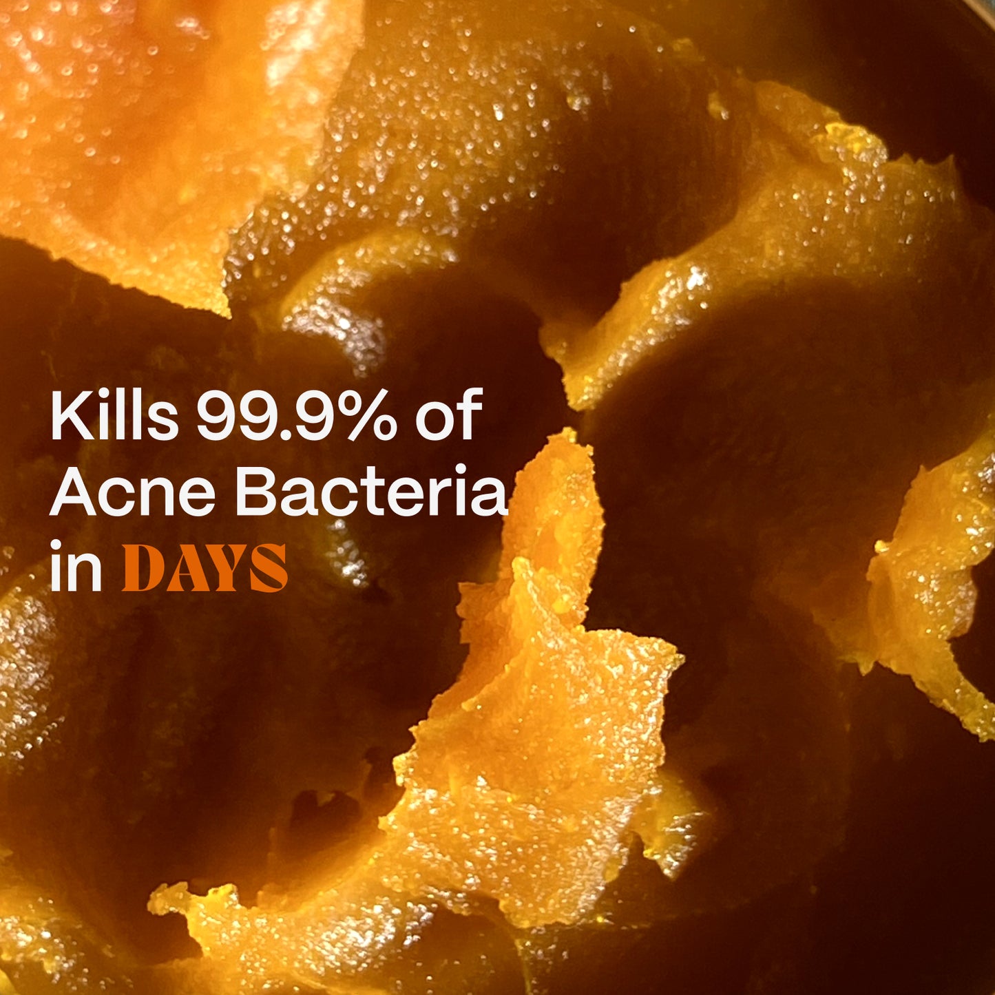 The Complete Acne Killer System 2.0