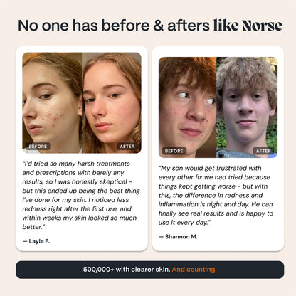 Sistema Completo Acne Killer 2.0
