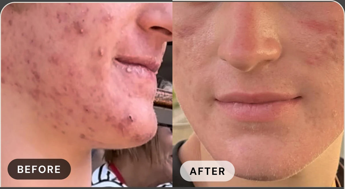 Mandy R. before treatment with acne, and after with clear skin
