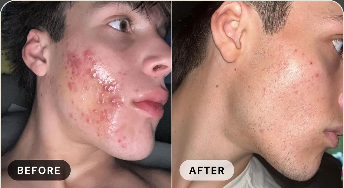 Preston S. before treatment with acne, and after with clear skin