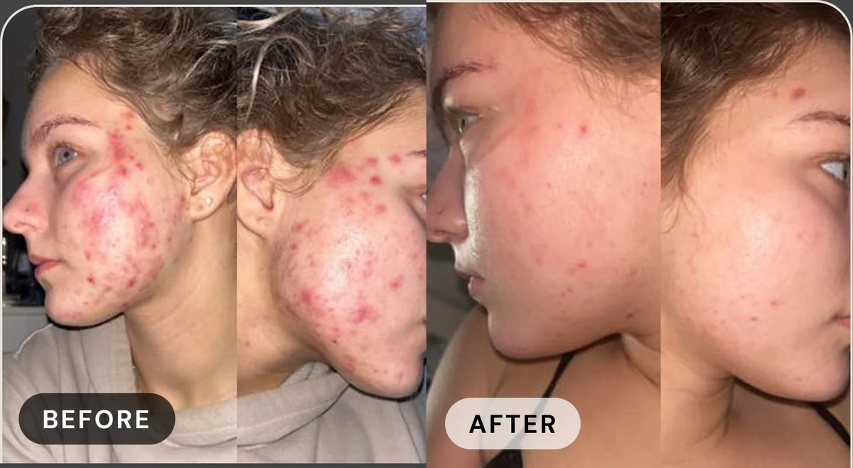 Eleonora C. before treatment with acne, and after with clear skin