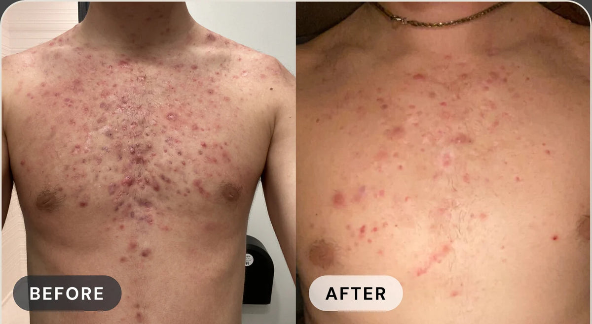 Daniel J. before treatment with acne, and after with clear skin