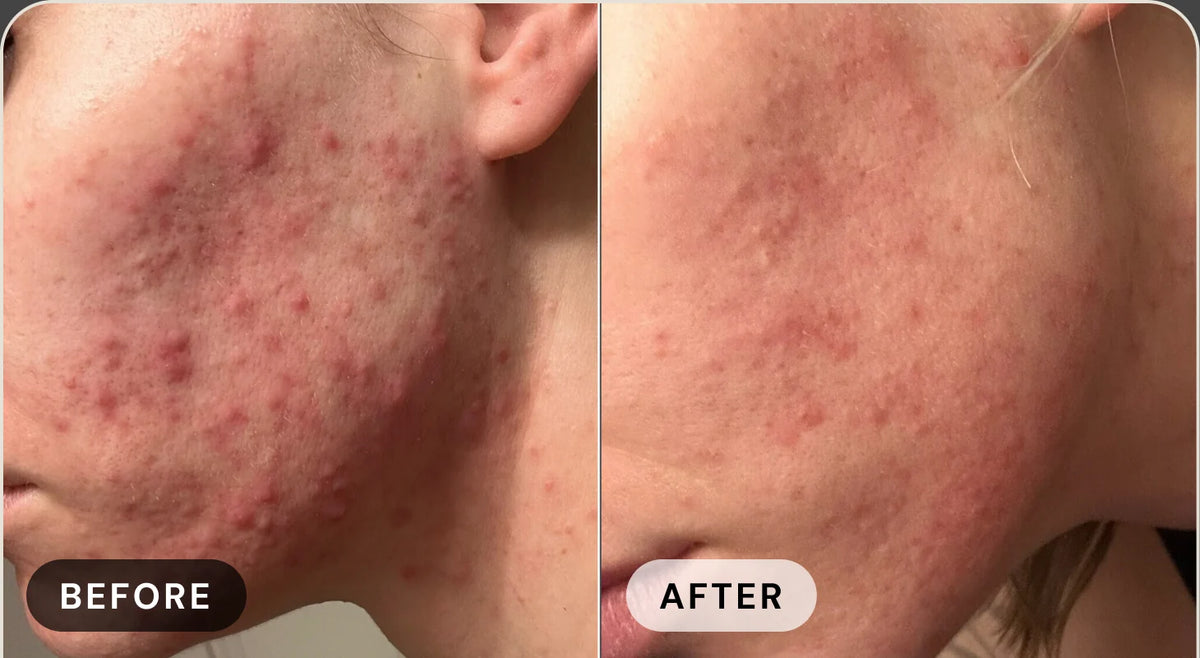 Michelle D. before treatment with acne, and after with clear skin