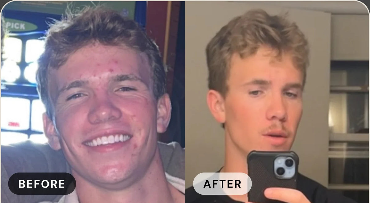 McRae L. before treatment with acne, and after with clear skin