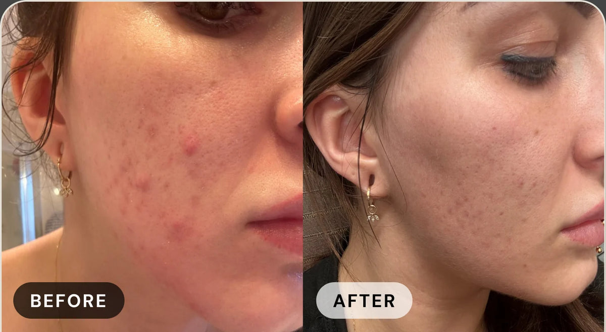 Karen M. before treatment with acne, and after with clear skin