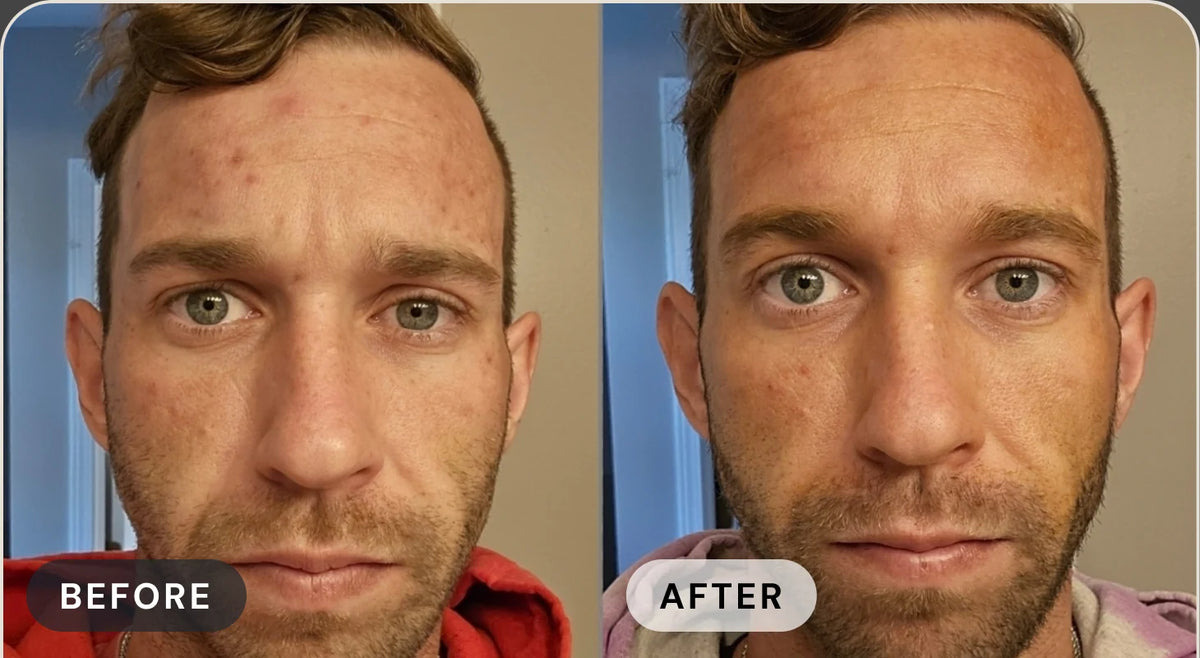 Nicholas P. before treatment with acne, and after with clear skin