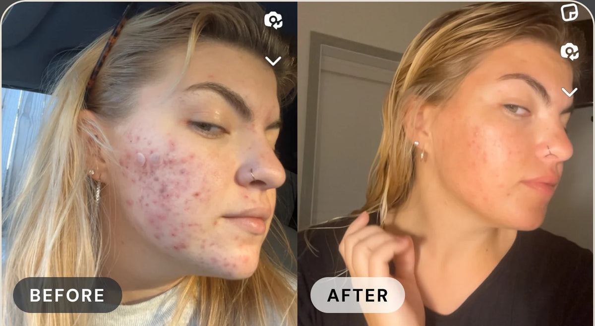 Shelby F. before treatment with acne, and after with clear skin