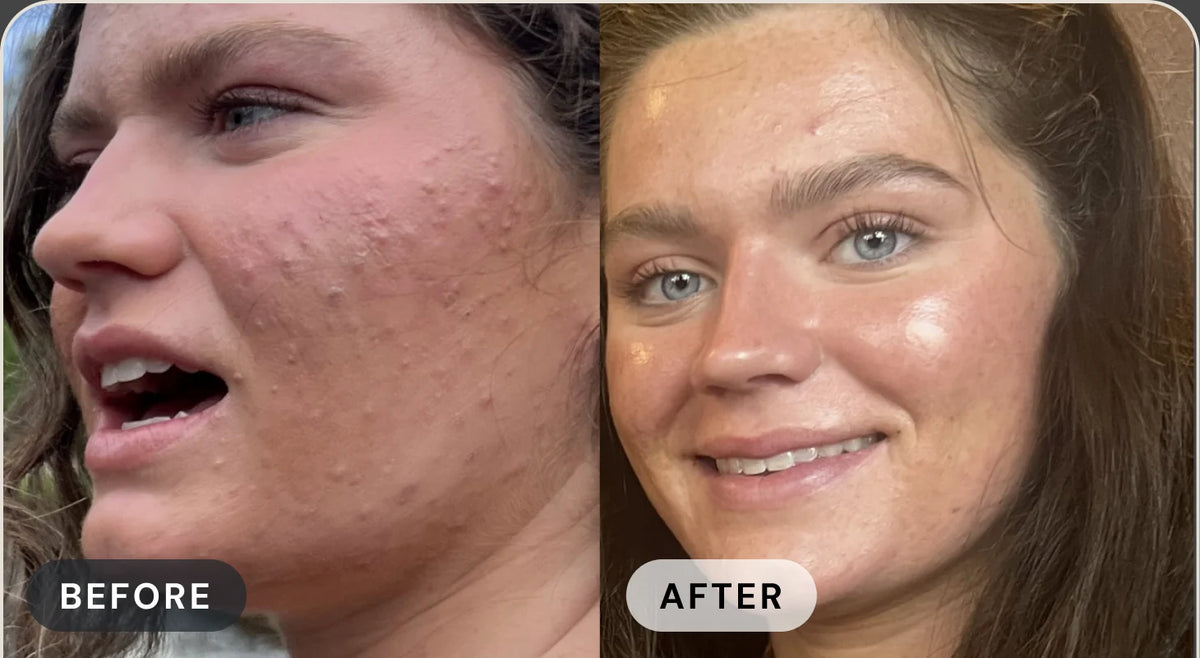 Patricia P. before treatment with acne, and after with clear skin