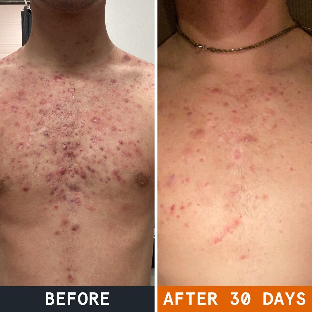 Body Balm for Acne Prone Skin before and after