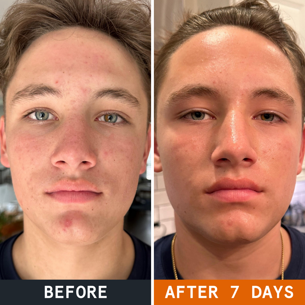 Complete Gut Repair & Hormonal Balance System before and after