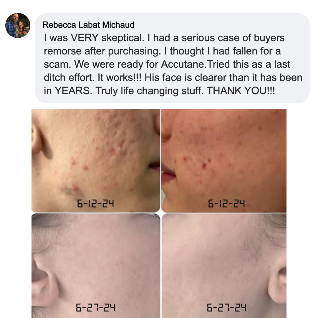 Kill Acne & Redness Ritual