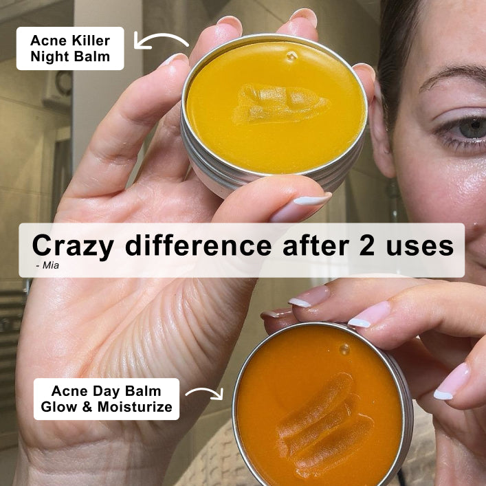 The Complete Acne Killer System 2.0