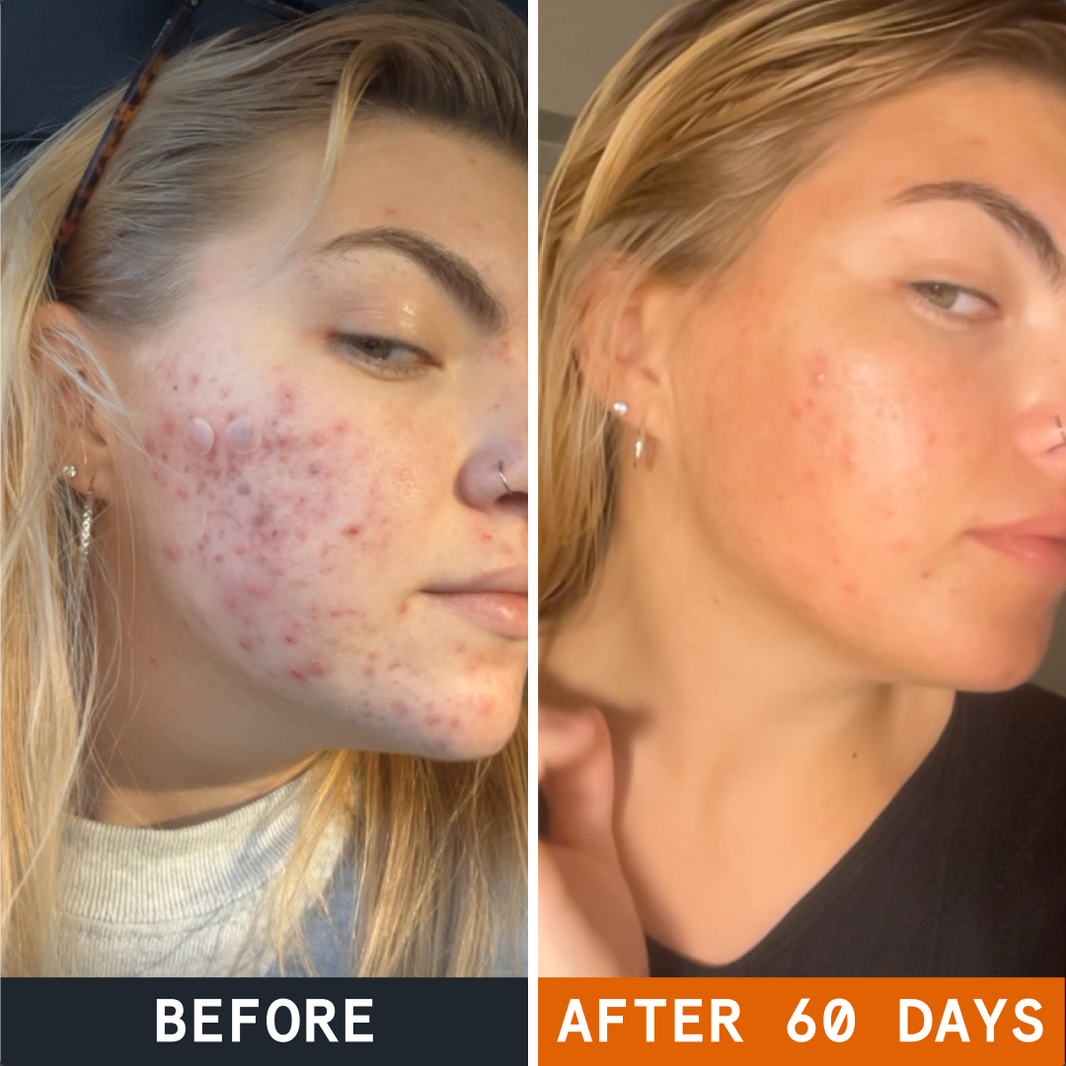 Kill Acne & Redness Ritual before and after