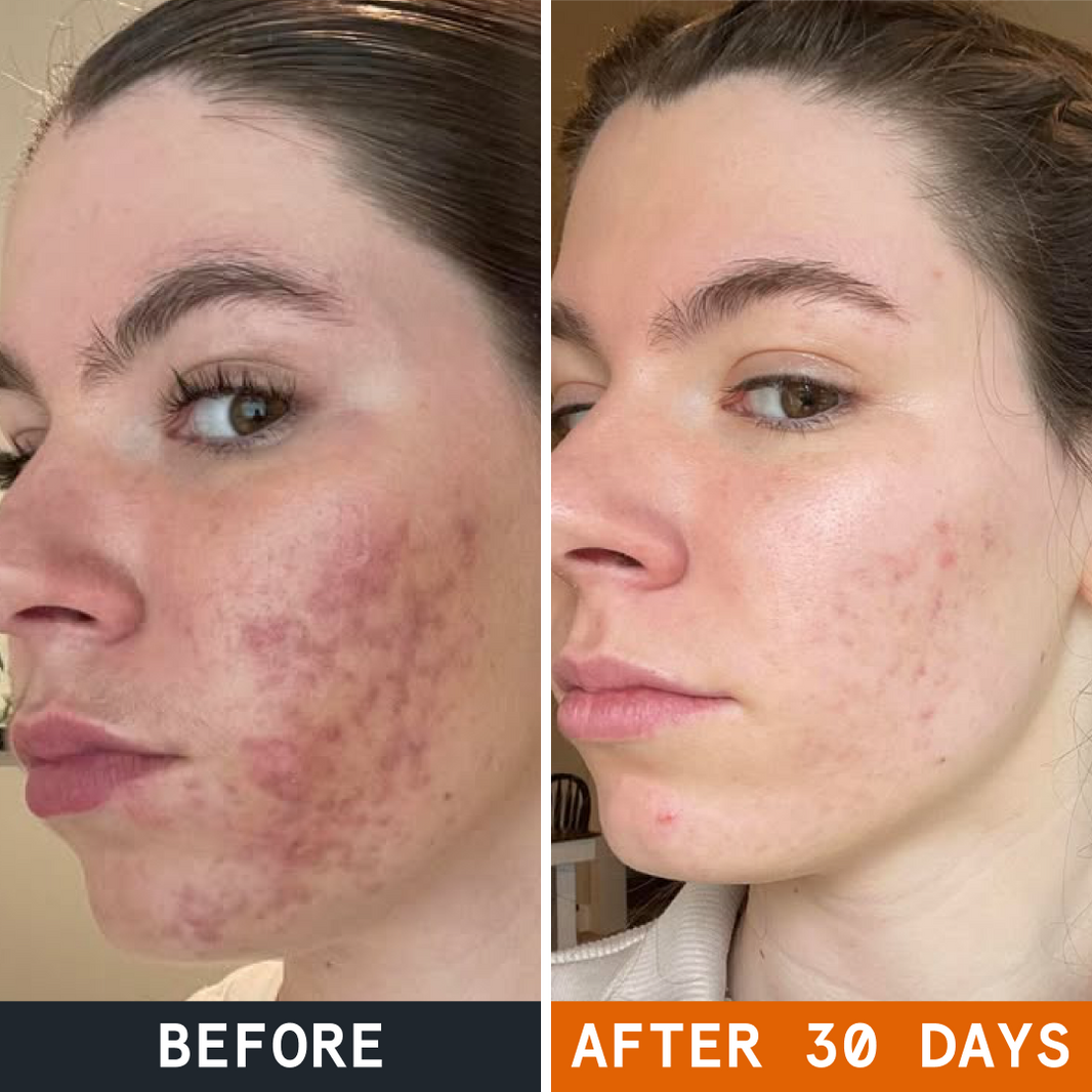 Pimple Scars Balm 2.0 before and after