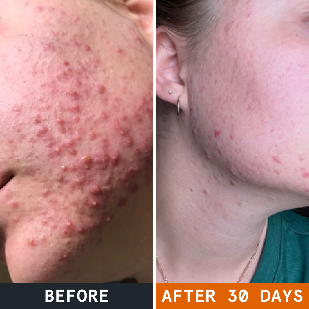 Pimple Stopper Day Balm before and after