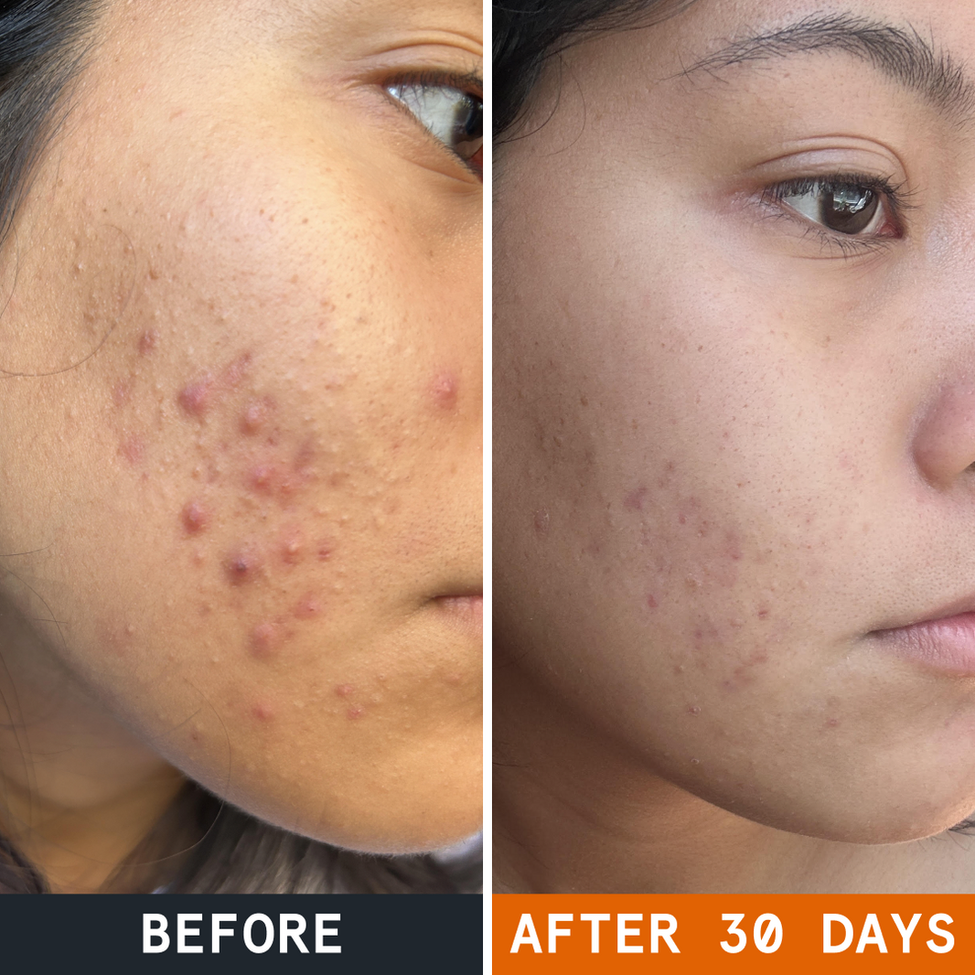Pimple Stopper Night Balm before and after