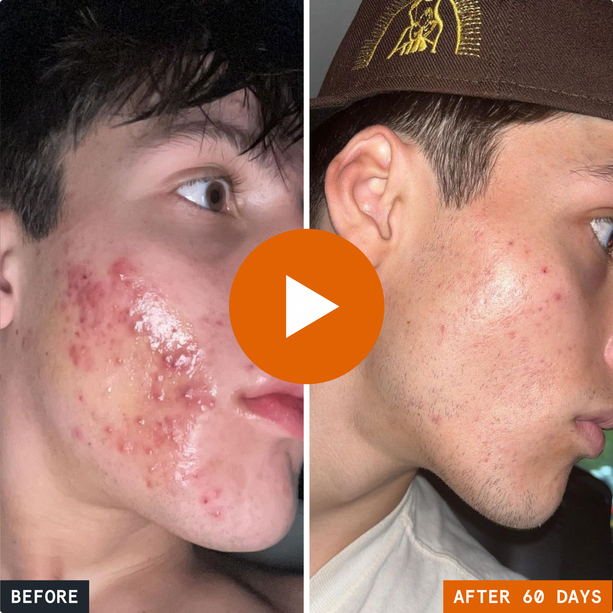 Complete Acne Killer System 2.0 | Acne Skin Care Products – Norse