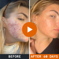 The Complete System for Acne-Prone Skin - Slide 11