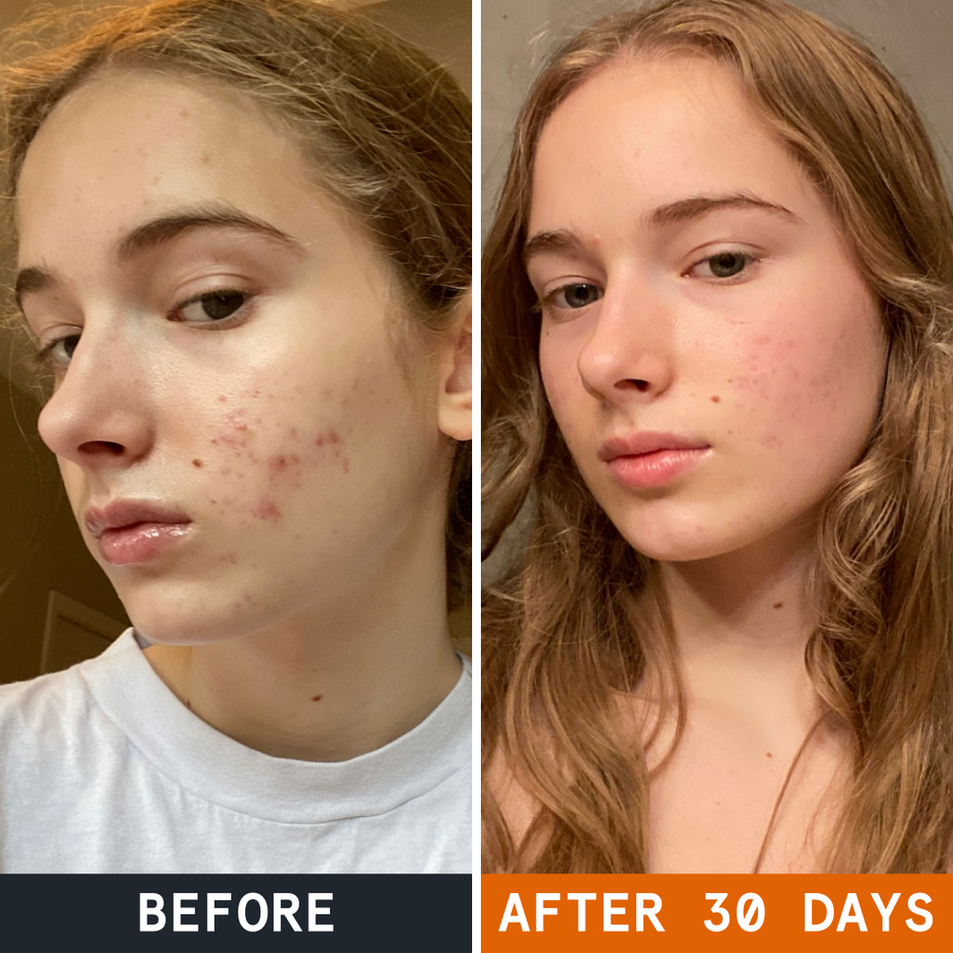Scrub for Acne Prone Skin before and after