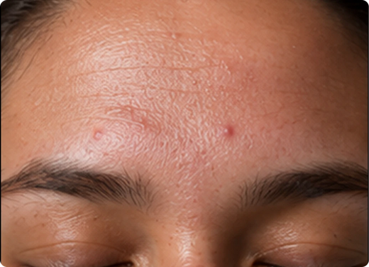 Nose and forehead