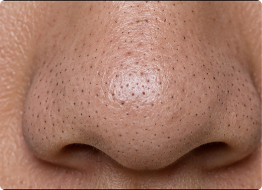 Blackheads