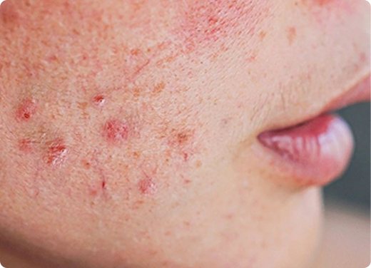 Red, inflamed spots