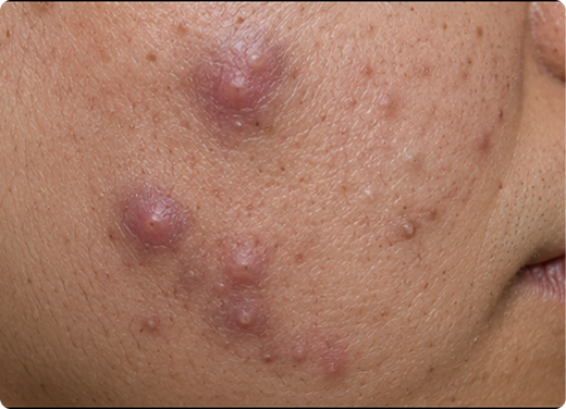 Deep, painful lumps