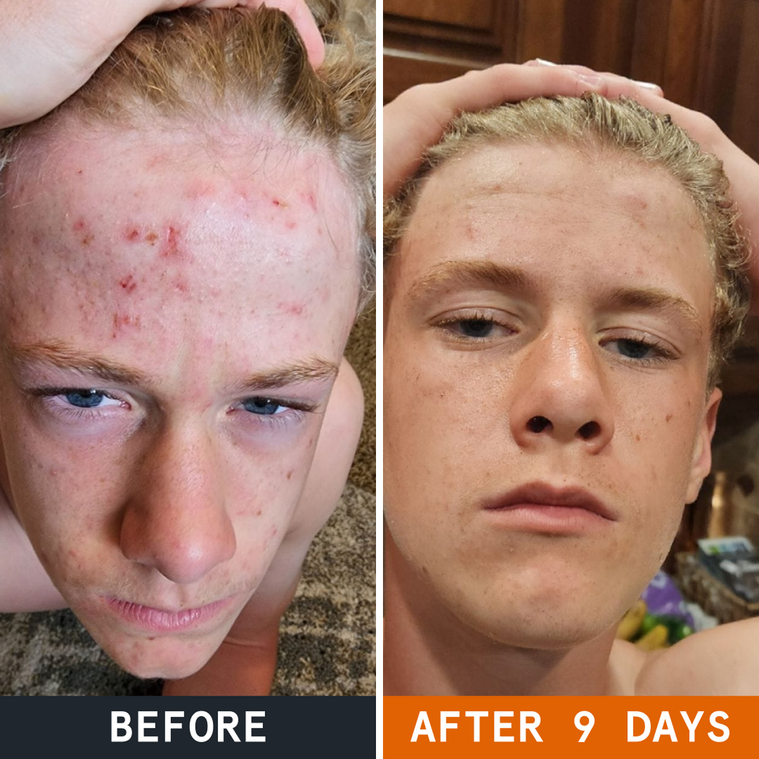 The Complete Acne Killer System 2.0 before and after
